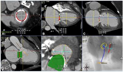 Mitral Valve-in-Valve Implant of a Balloon-Expandable Valve Guided by 3-Dimensional Printing